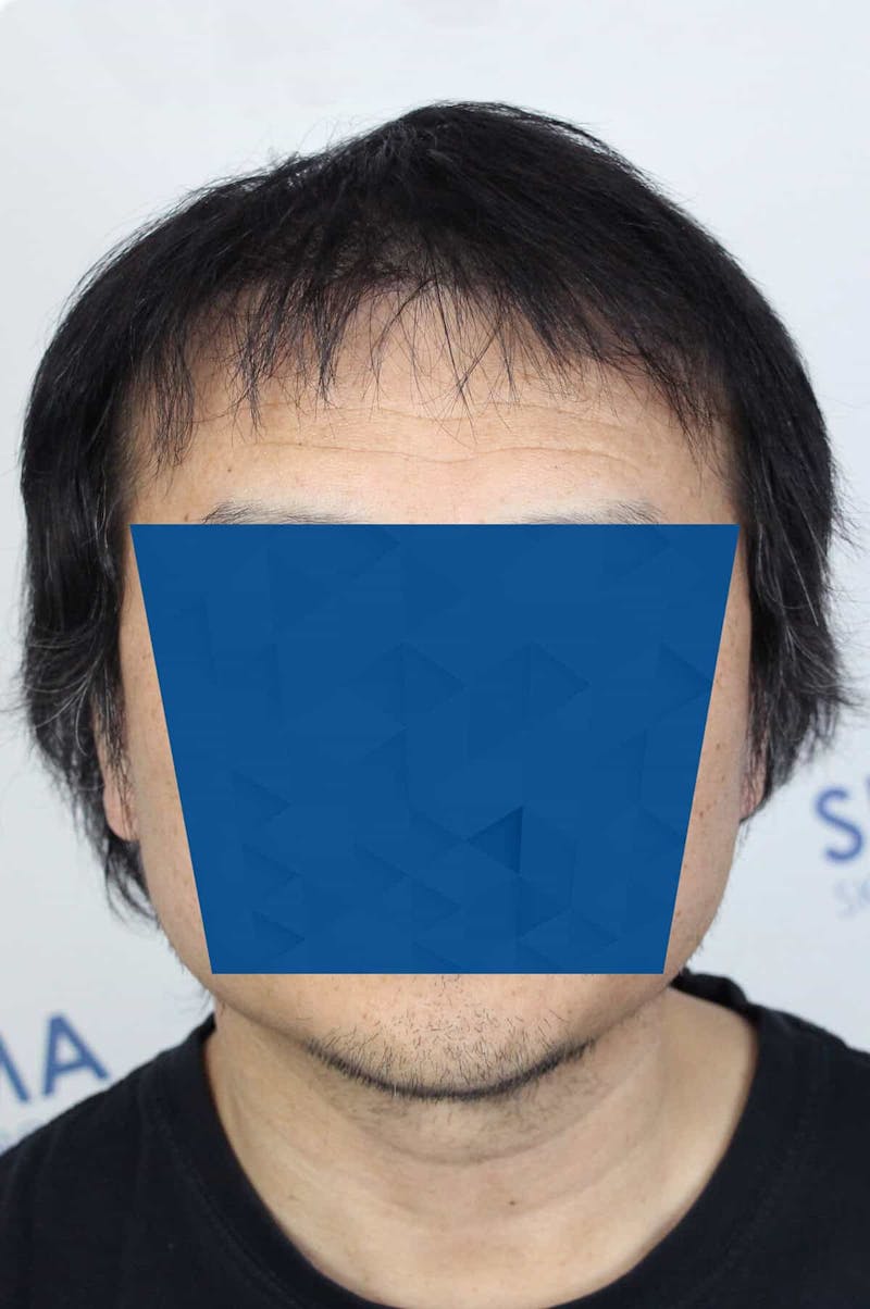 Results Before & After Gallery - Patient 339366 - Image 2