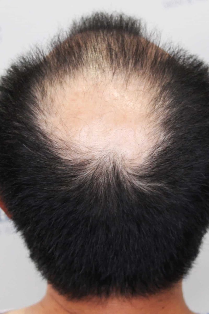 Results Before & After Gallery - Patient 339366 - Image 3