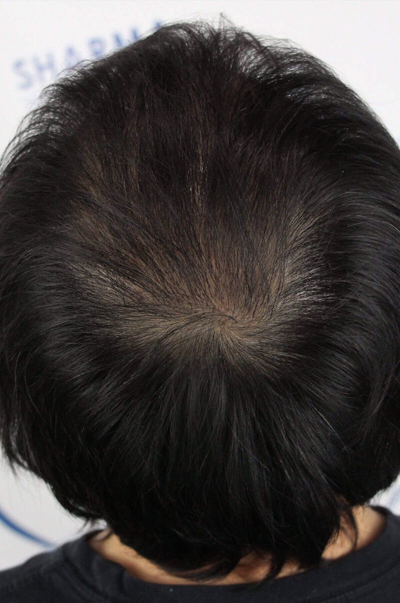Results Before & After Gallery - Patient 339366 - Image 4
