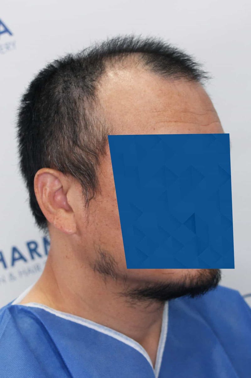 Results Before & After Gallery - Patient 339366 - Image 5