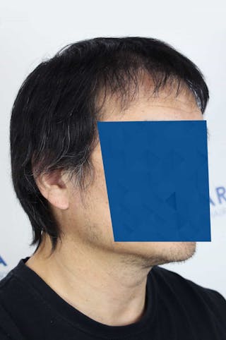 Results Before & After Gallery - Patient 339366 - Image 6