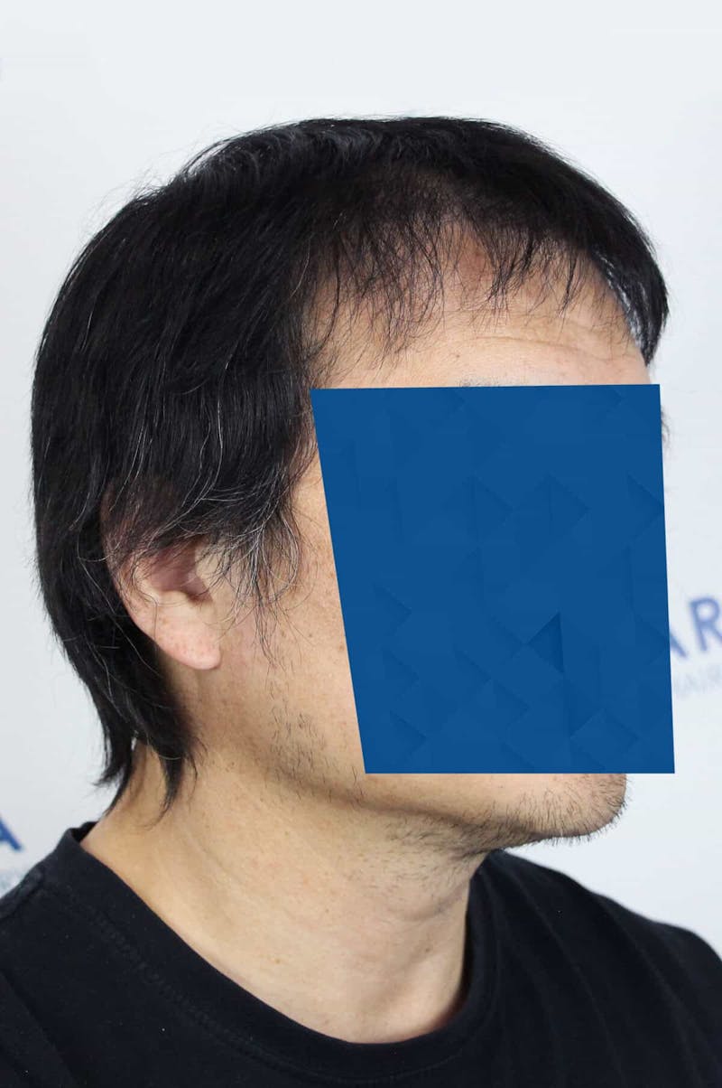 Results Before & After Gallery - Patient 339366 - Image 6