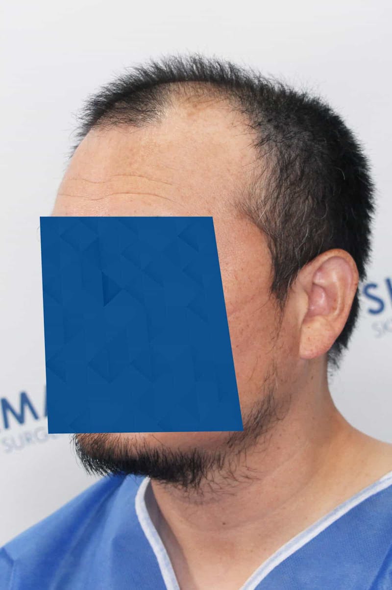Results Before & After Gallery - Patient 339366 - Image 7