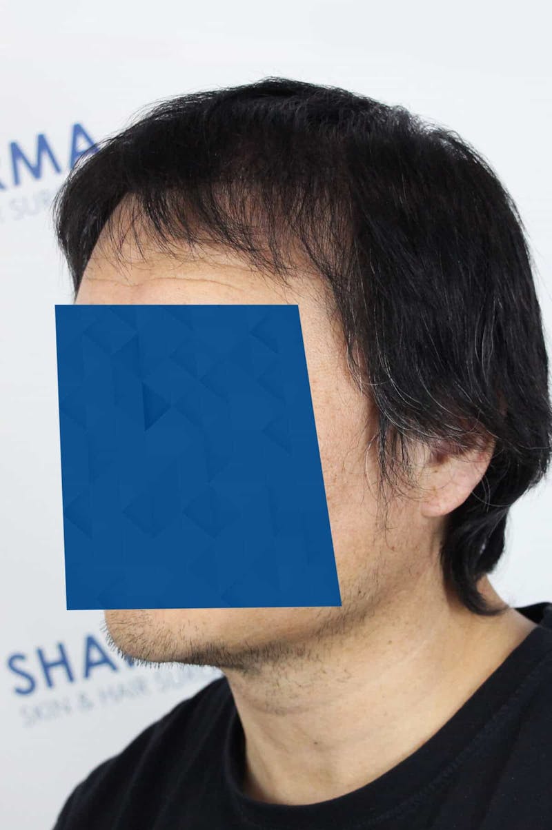 Results Before & After Gallery - Patient 339366 - Image 8