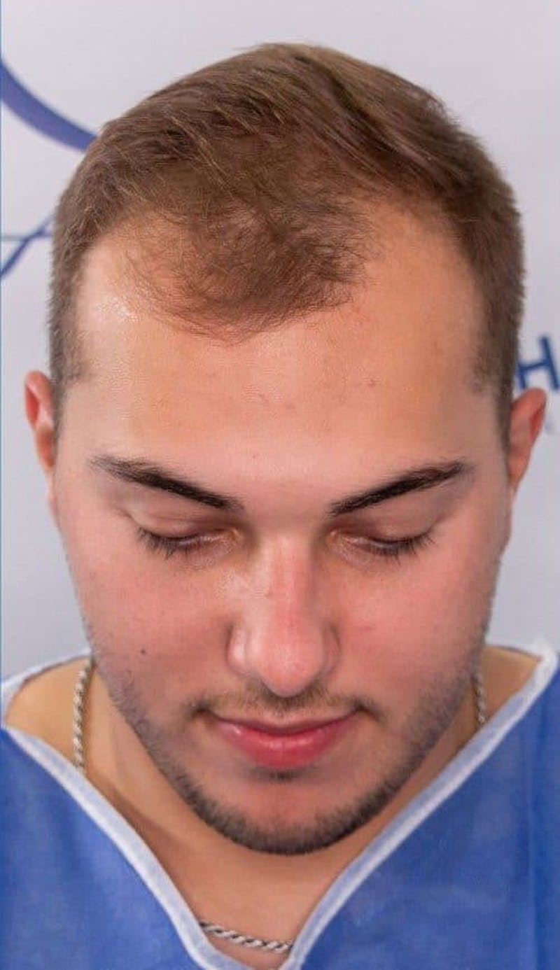 Results Before & After Gallery - Patient 375090 - Image 1
