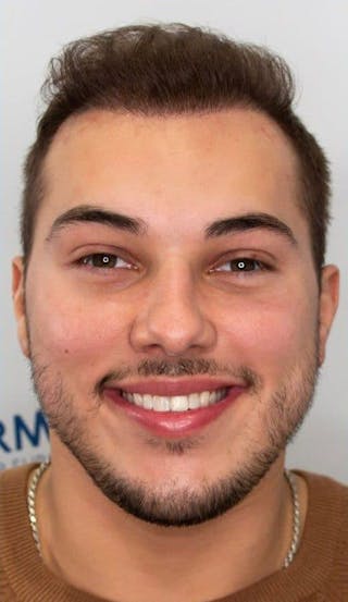 Results Before & After Gallery - Patient 375090 - Image 2