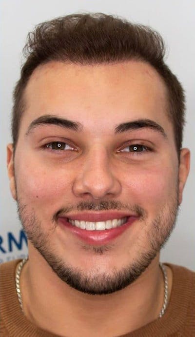 Results Before & After Gallery - Patient 375090 - Image 2