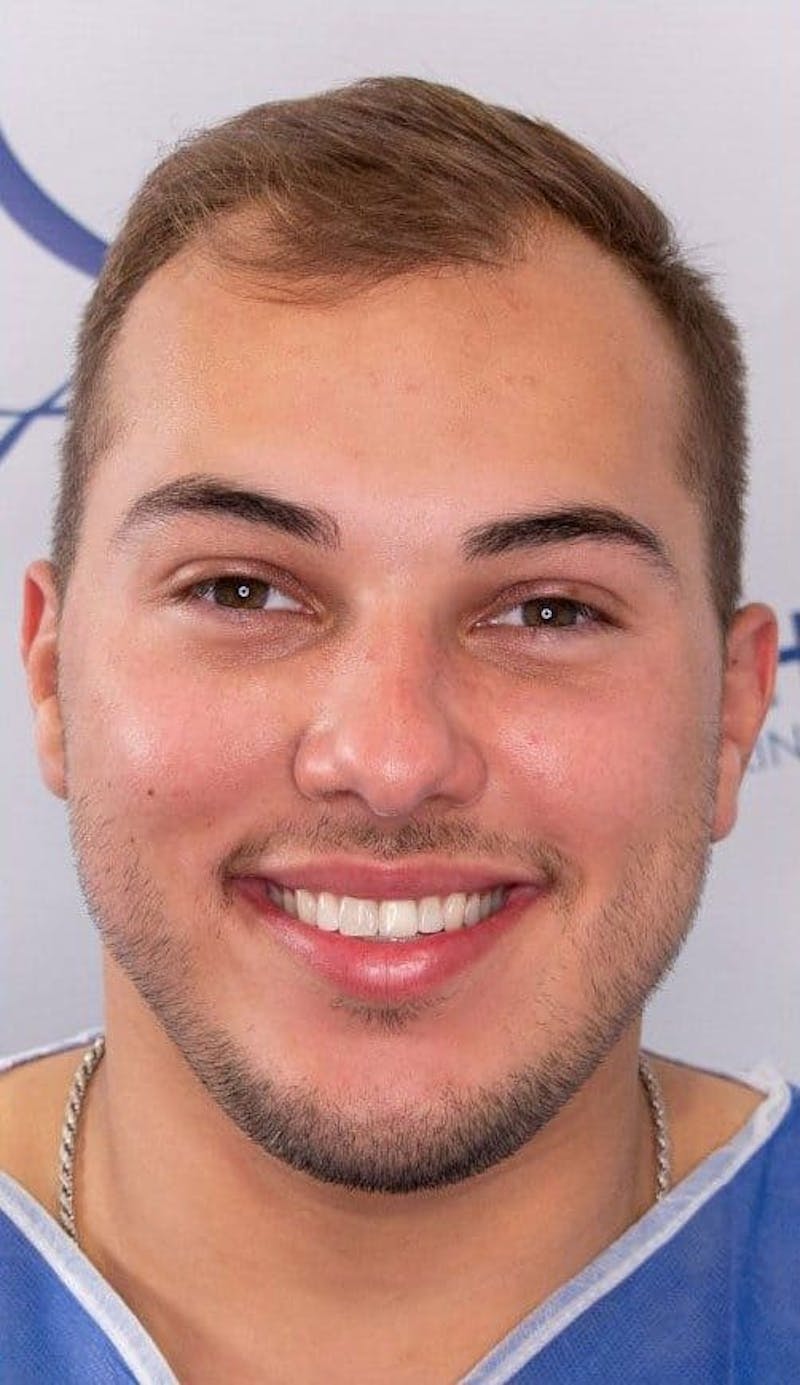 Results Before & After Gallery - Patient 375090 - Image 3