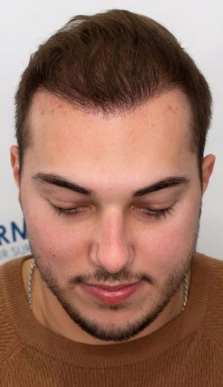 Results Before & After Gallery - Patient 375090 - Image 4