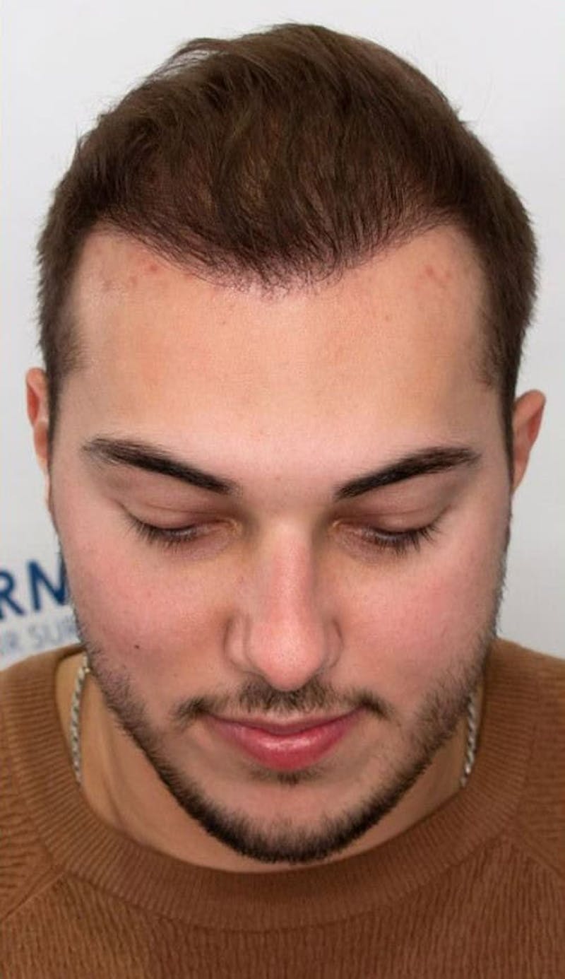 Results Before & After Gallery - Patient 375090 - Image 4