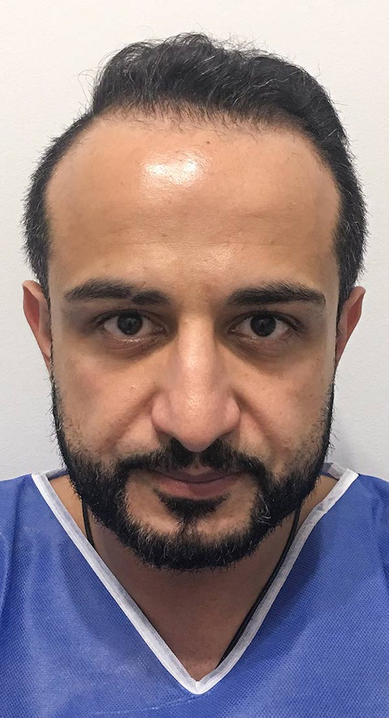 Results Before & After Gallery - Patient 416182 - Image 1