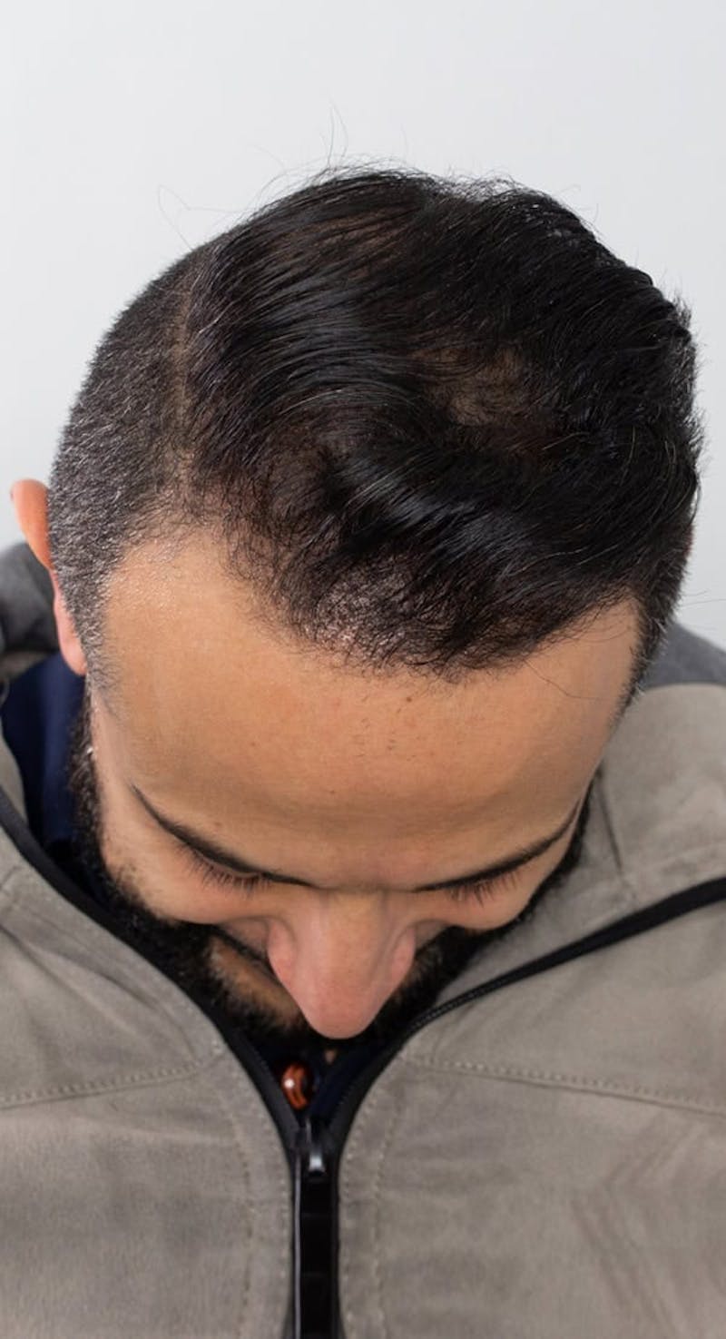Results Before & After Gallery - Patient 416182 - Image 4