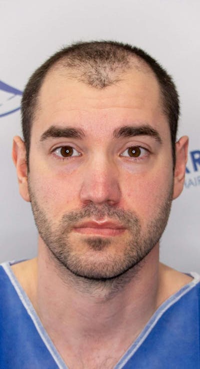Results Before & After Gallery - Patient 281527 - Image 1