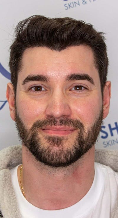 Results Before & After Gallery - Patient 281527 - Image 2