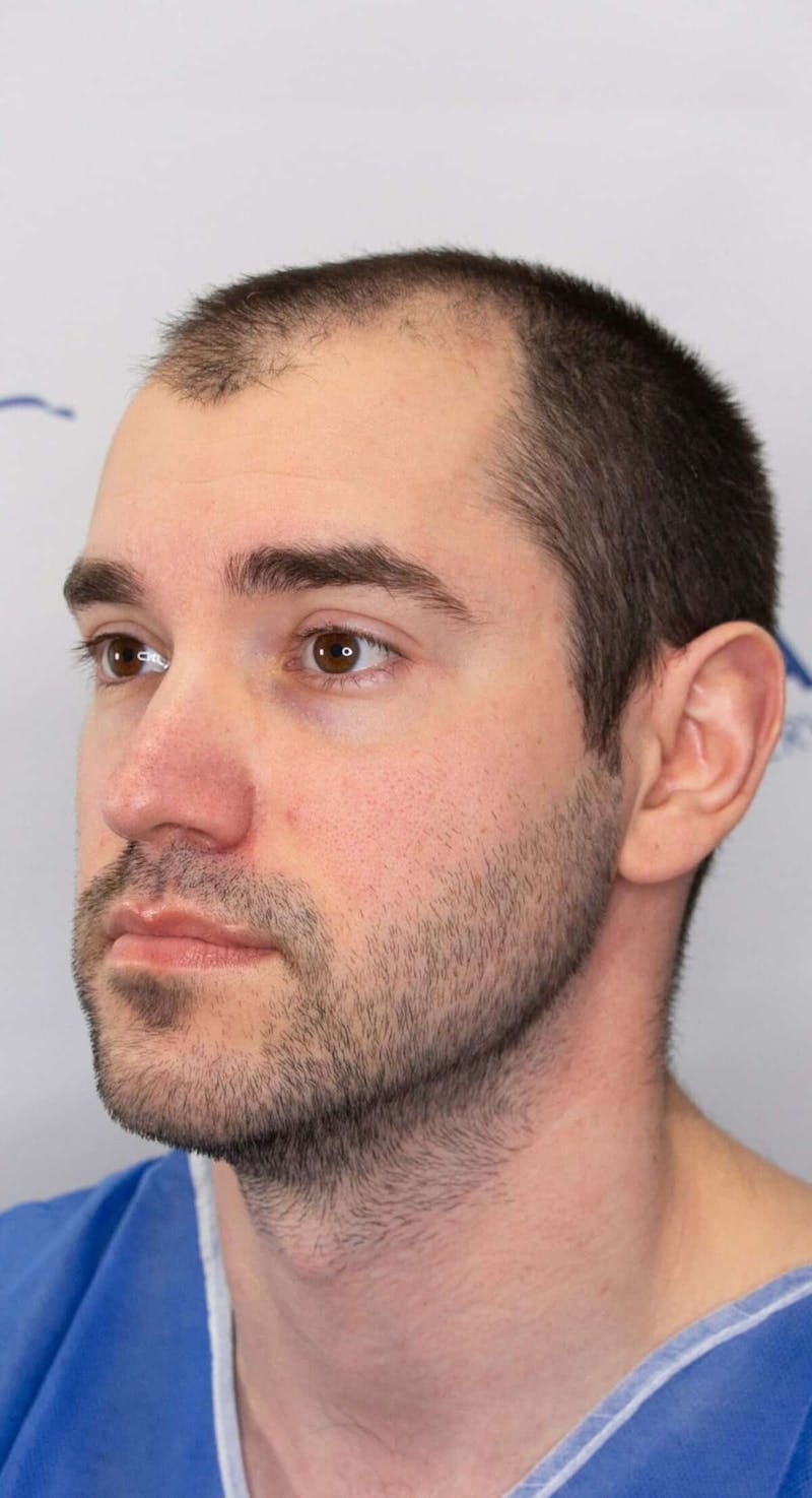 Results Before & After Gallery - Patient 281527 - Image 3