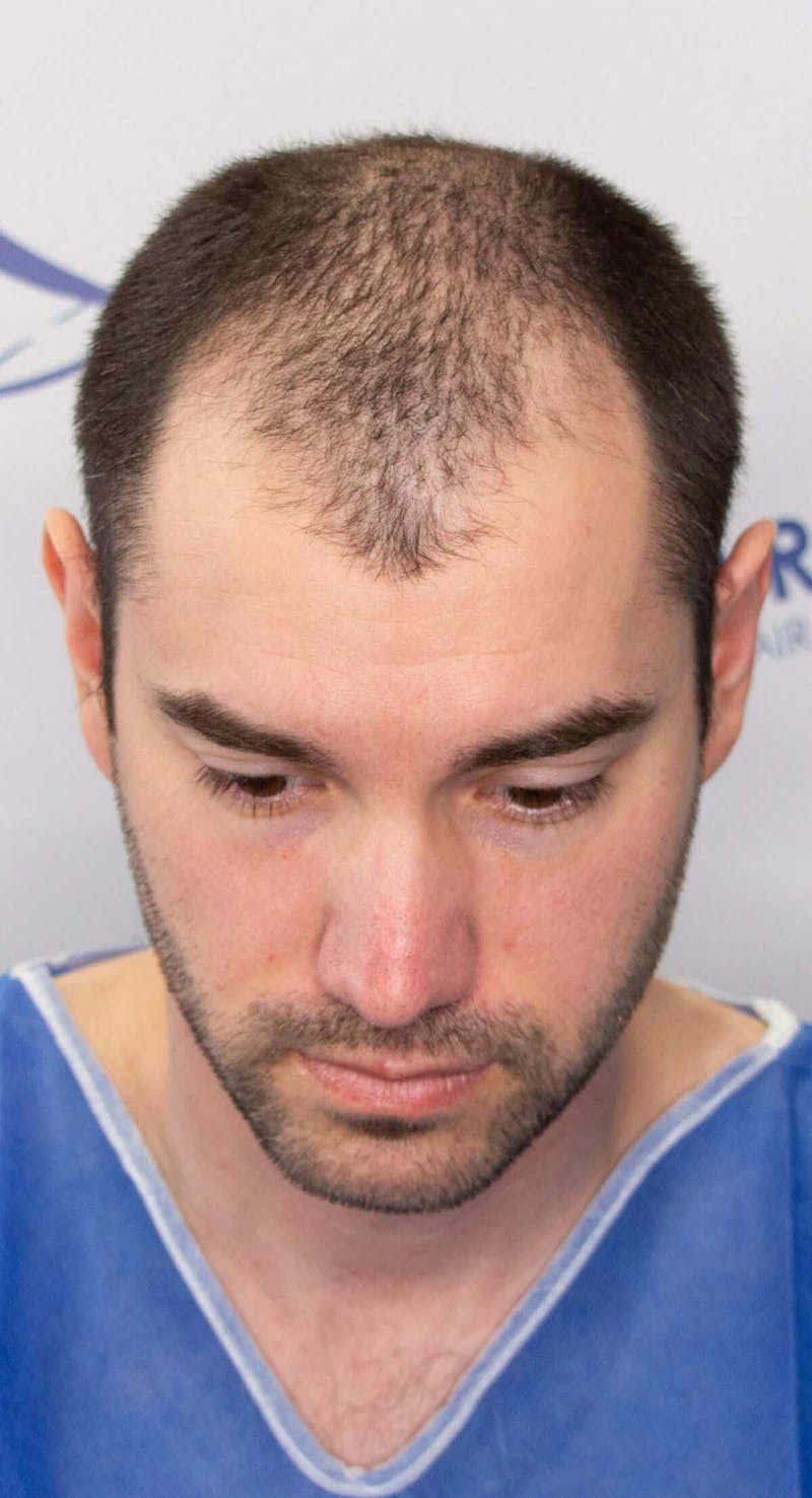 Results Before & After Gallery - Patient 281527 - Image 5