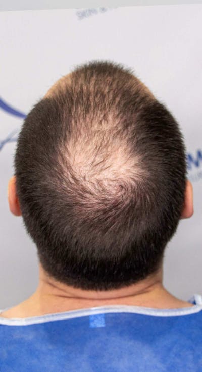 Results Before & After Gallery - Patient 228580 - Image 1