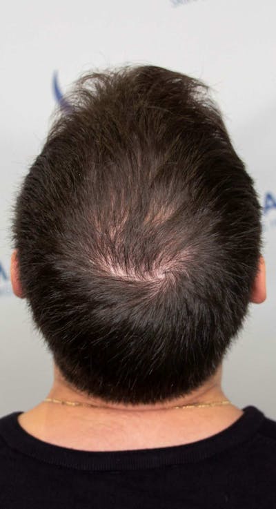 Results Before & After Gallery - Patient 228580 - Image 2