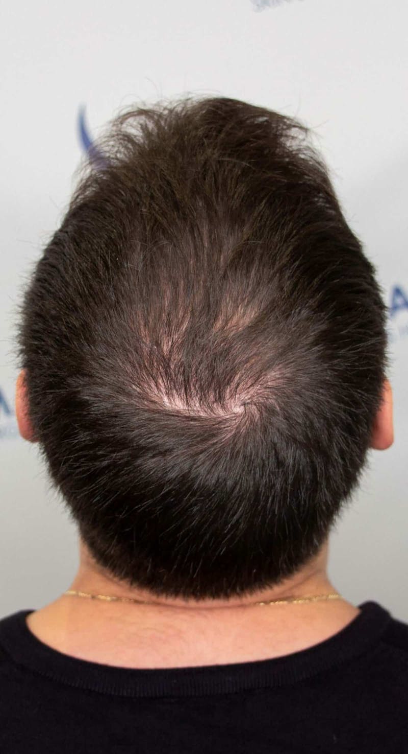 Results Before & After Gallery - Patient 228580 - Image 2