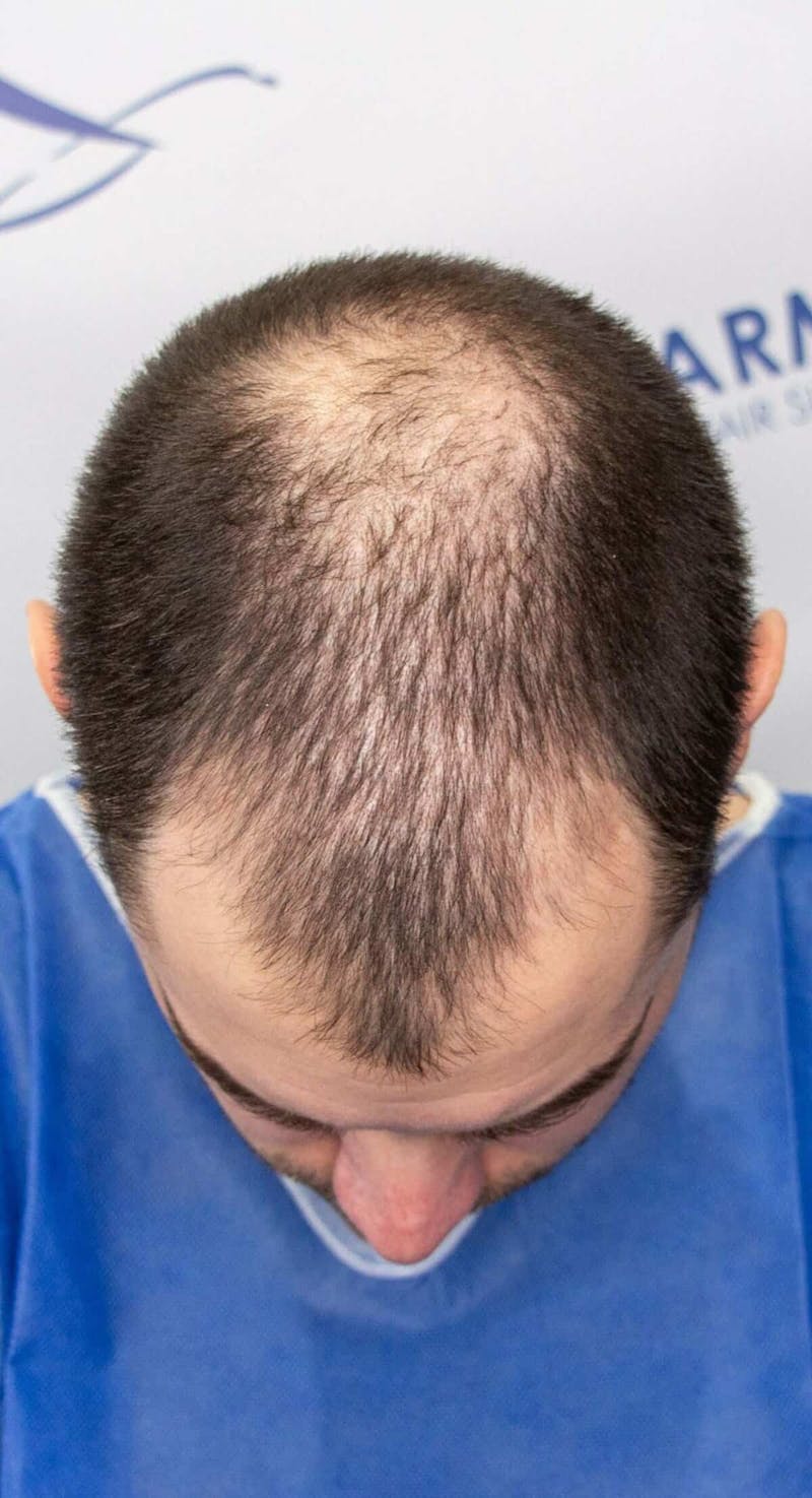 Results Before & After Gallery - Patient 228580 - Image 3