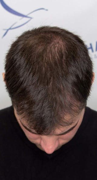 Results Before & After Gallery - Patient 228580 - Image 4