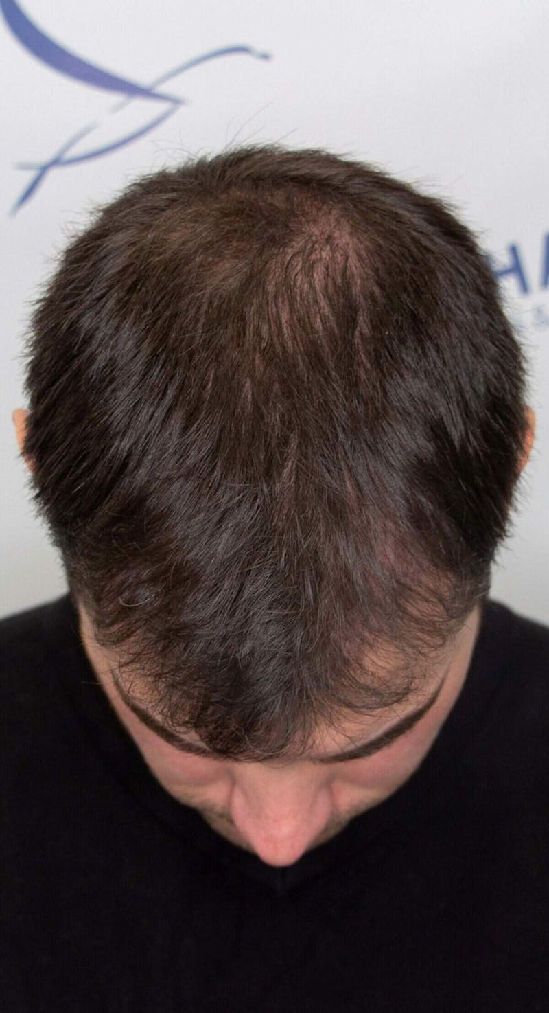 Results Before & After Gallery - Patient 228580 - Image 4