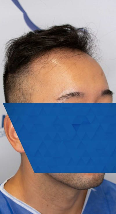 Results Before & After Gallery - Patient 340207 - Image 1