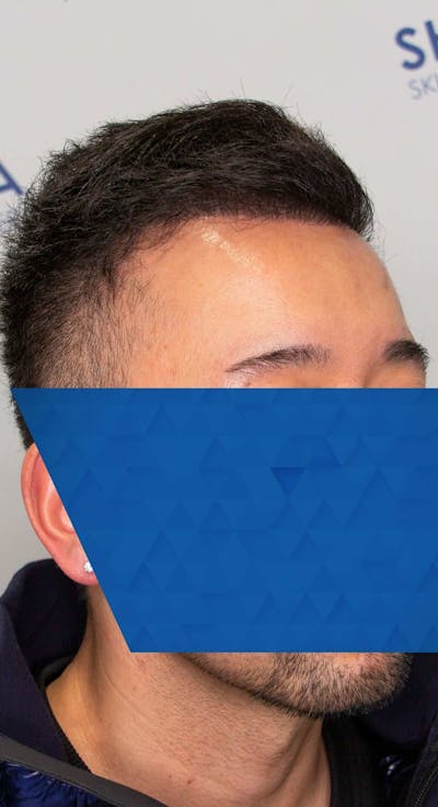 Results Before & After Gallery - Patient 340207 - Image 2