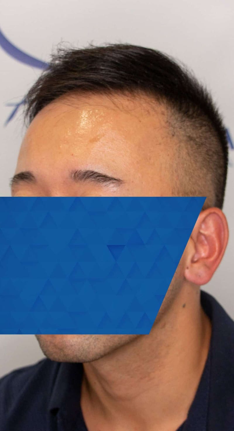 Results Before & After Gallery - Patient 340207 - Image 3