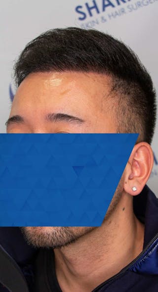 Results Before & After Gallery - Patient 340207 - Image 4