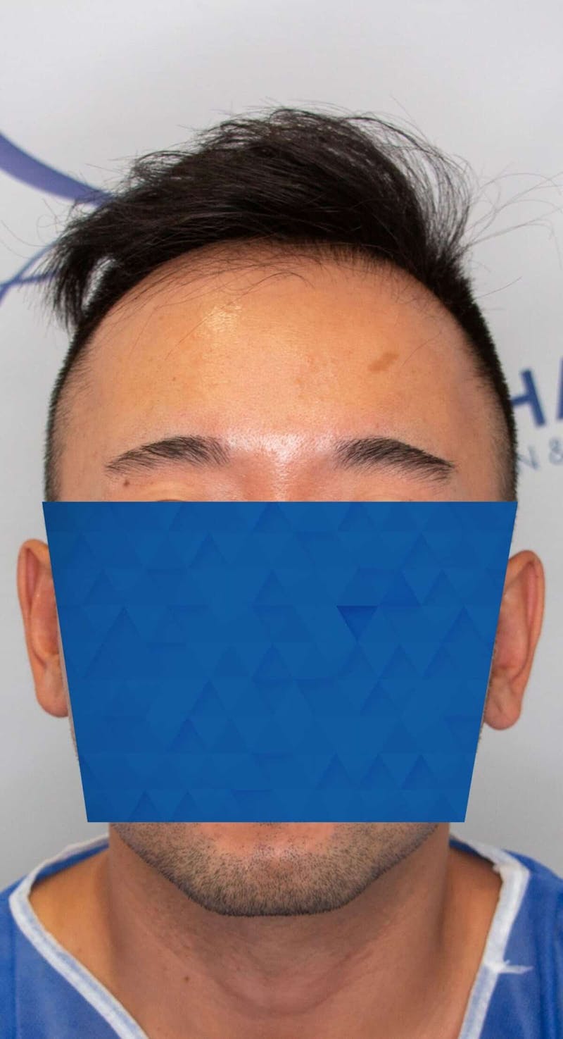 Results Before & After Gallery - Patient 340207 - Image 5