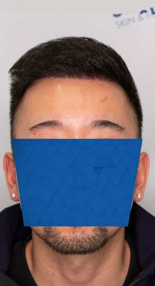 Results Before & After Gallery - Patient 340207 - Image 6