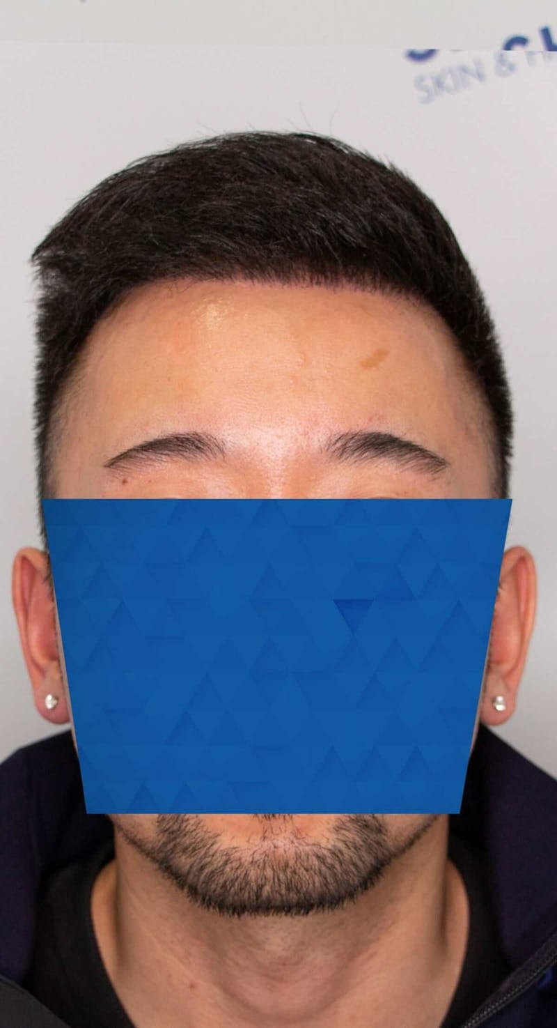 Results Before & After Gallery - Patient 340207 - Image 6