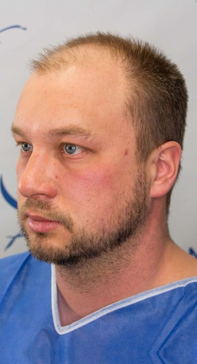Results Before & After Gallery - Patient 915330 - Image 1