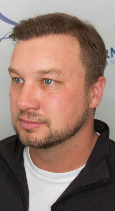 Results Before & After Gallery - Patient 915330 - Image 2