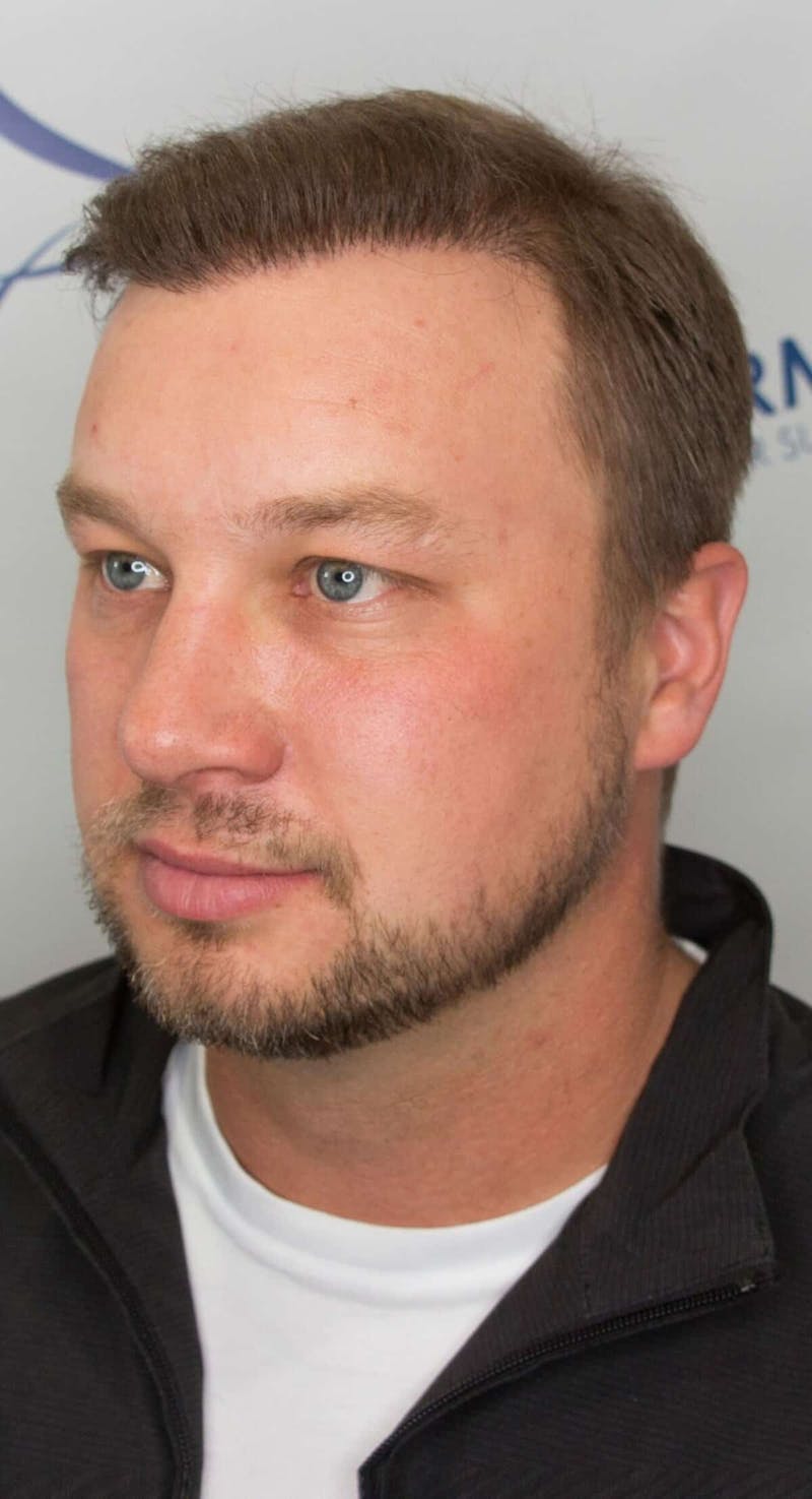Results Before & After Gallery - Patient 915330 - Image 2