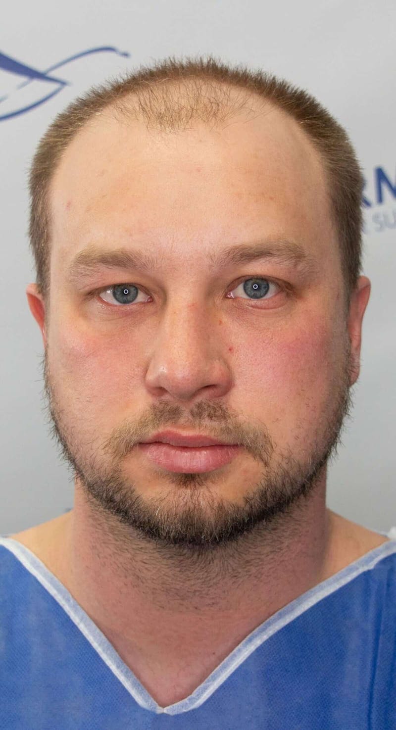 Results Before & After Gallery - Patient 915330 - Image 3