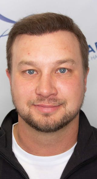 Results Before & After Gallery - Patient 915330 - Image 4