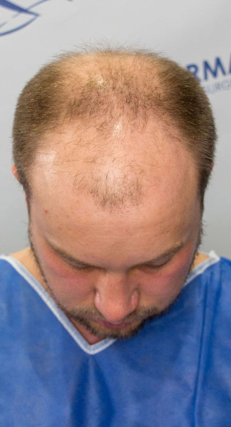 Results Before & After Gallery - Patient 915330 - Image 5