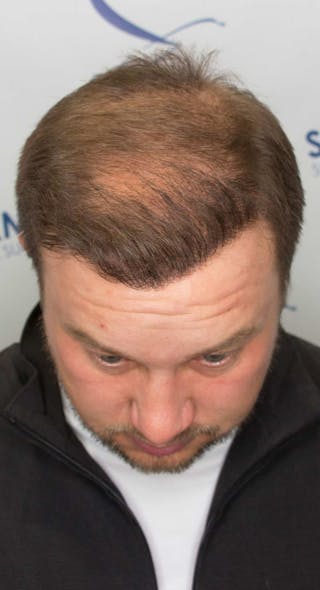 Results Before & After Gallery - Patient 915330 - Image 6