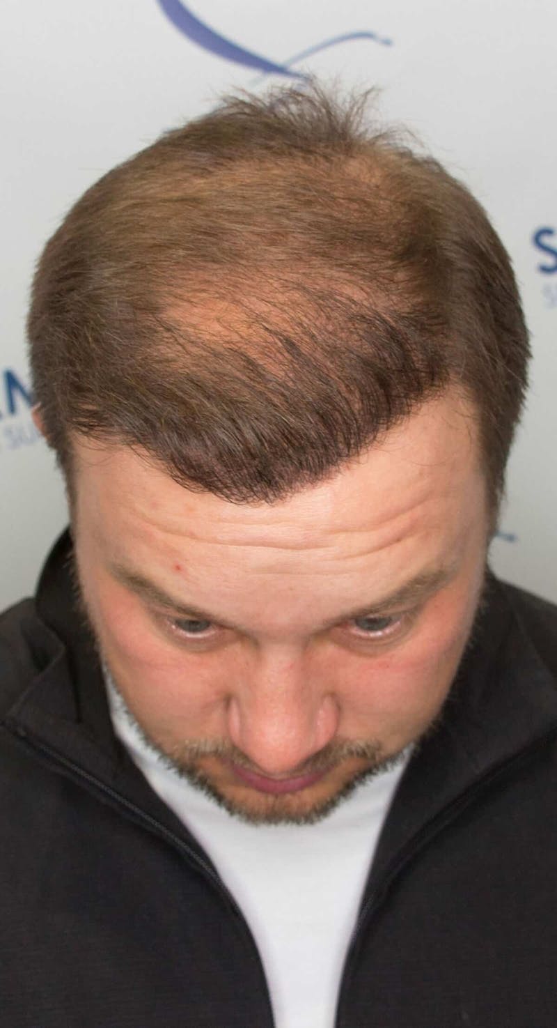 Results Before & After Gallery - Patient 915330 - Image 6