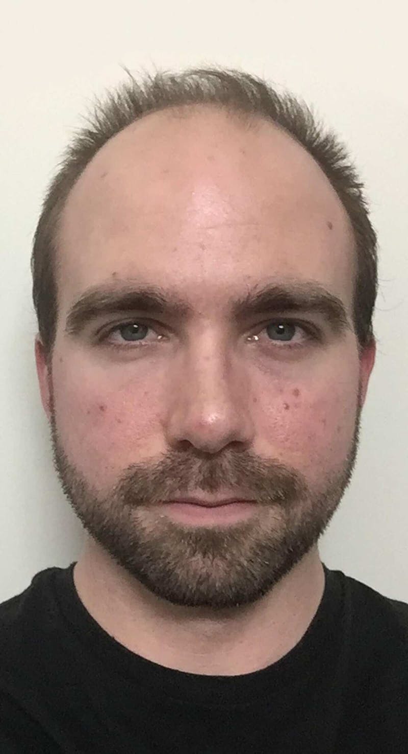 Results Before & After Gallery - Patient 144699 - Image 1