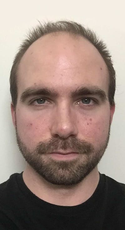 Results Before & After Gallery - Patient 144699 - Image 1