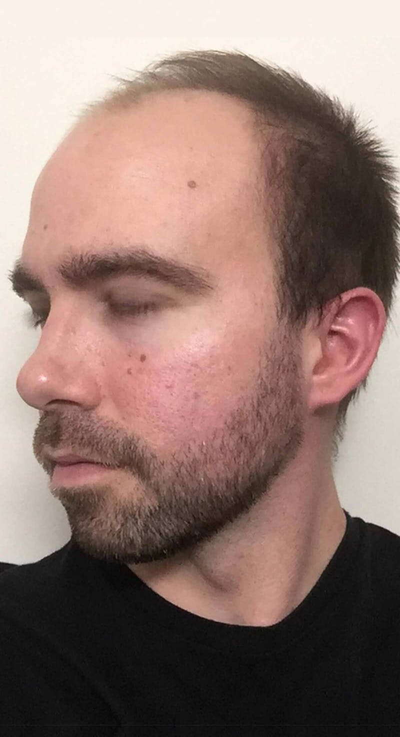 Results Before & After Gallery - Patient 144699 - Image 3