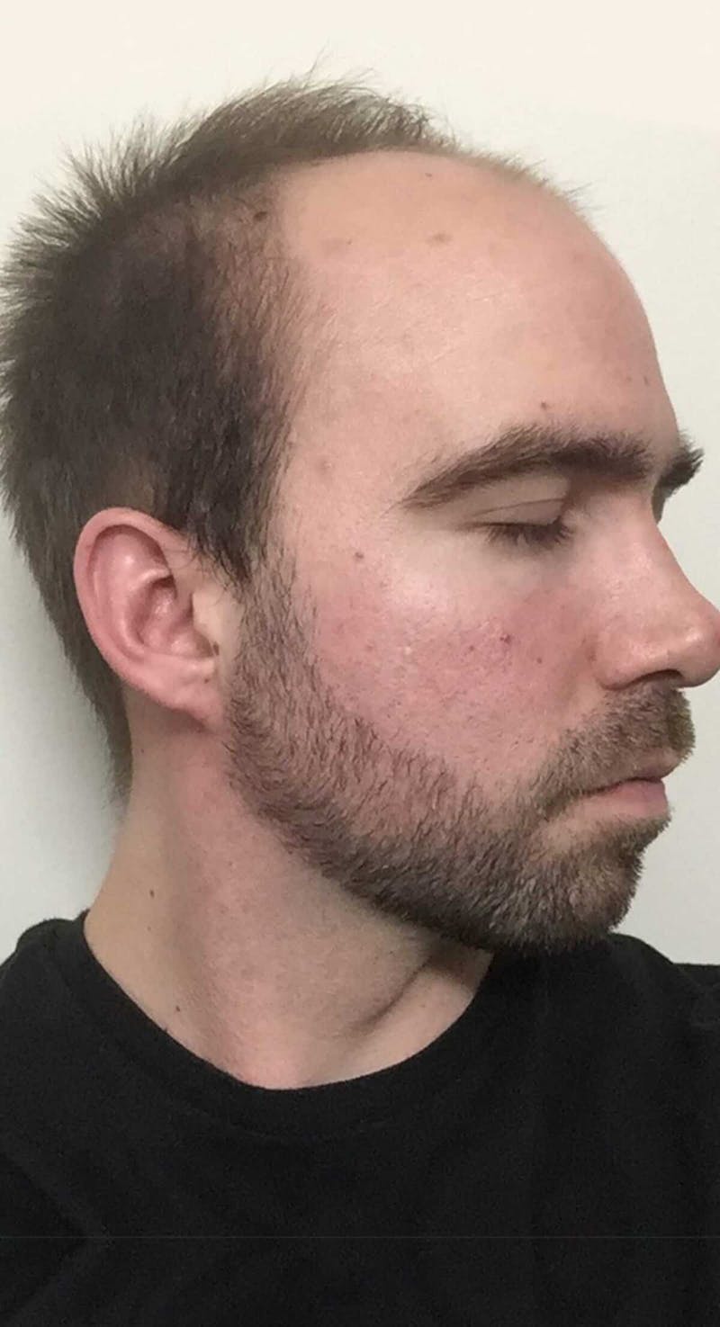 Results Before & After Gallery - Patient 144699 - Image 5