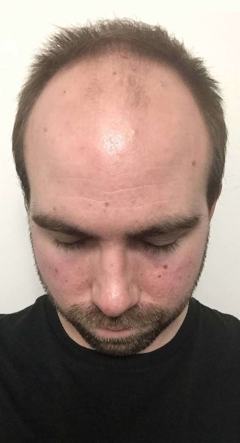 Results Before & After Gallery - Patient 144699 - Image 7