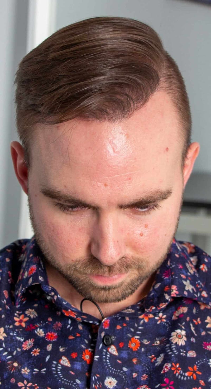 Results Before & After Gallery - Patient 144699 - Image 8