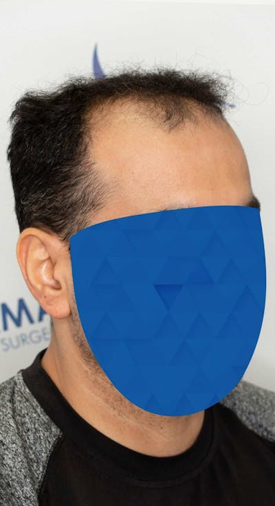 Results Before & After Gallery - Patient 369381 - Image 1