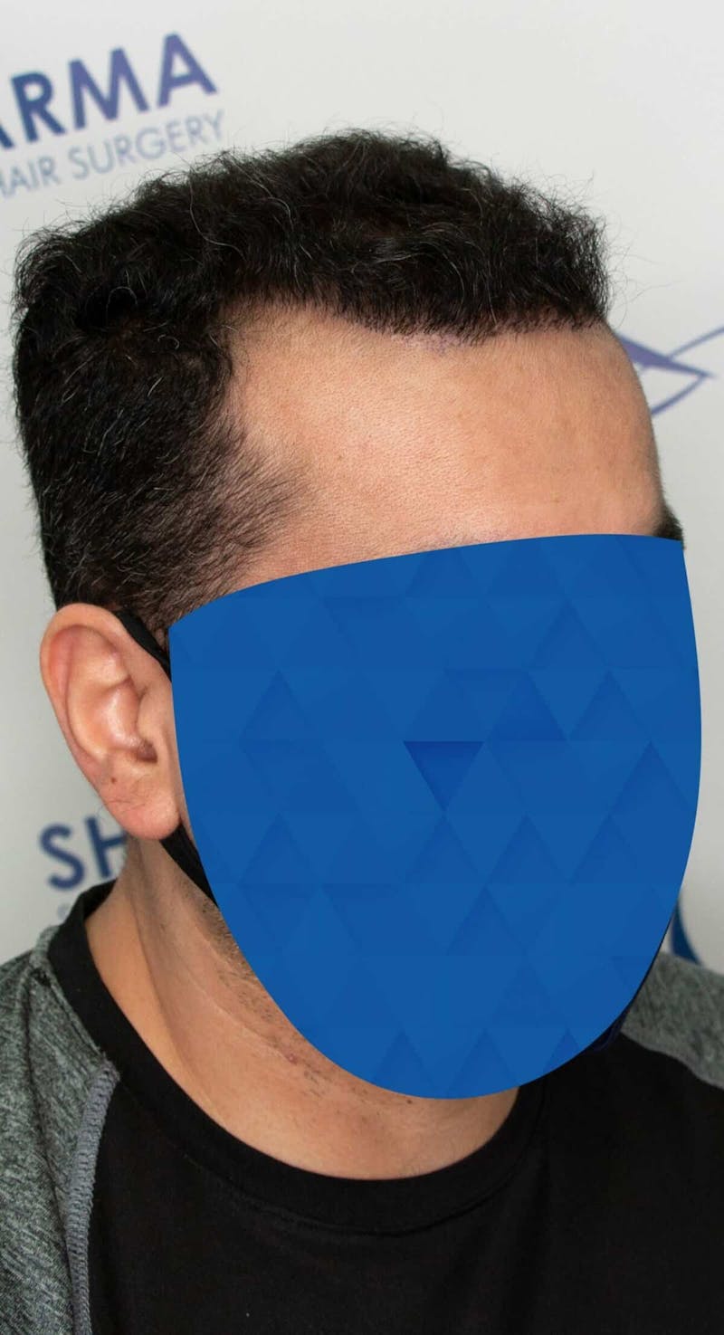 Results Before & After Gallery - Patient 369381 - Image 2