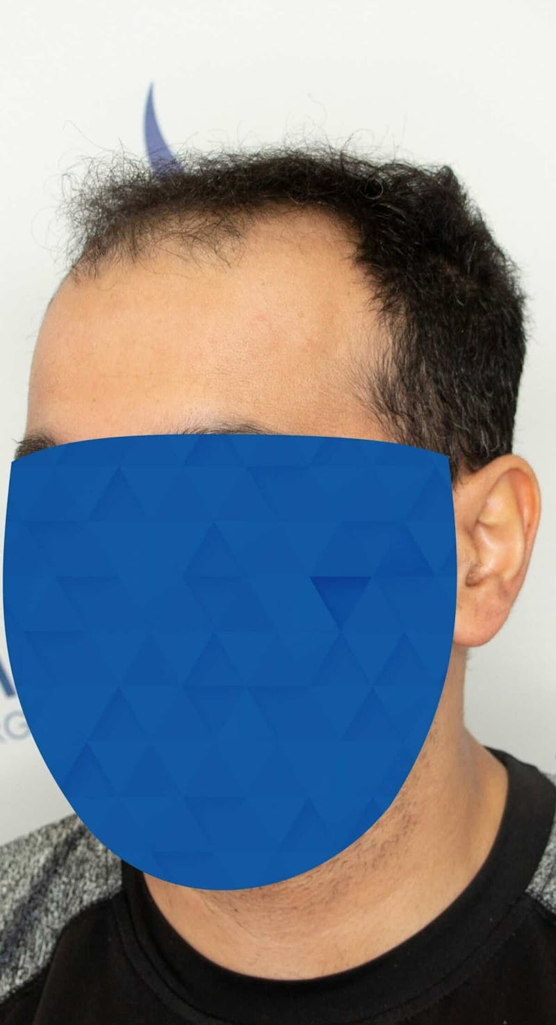Results Before & After Gallery - Patient 369381 - Image 3
